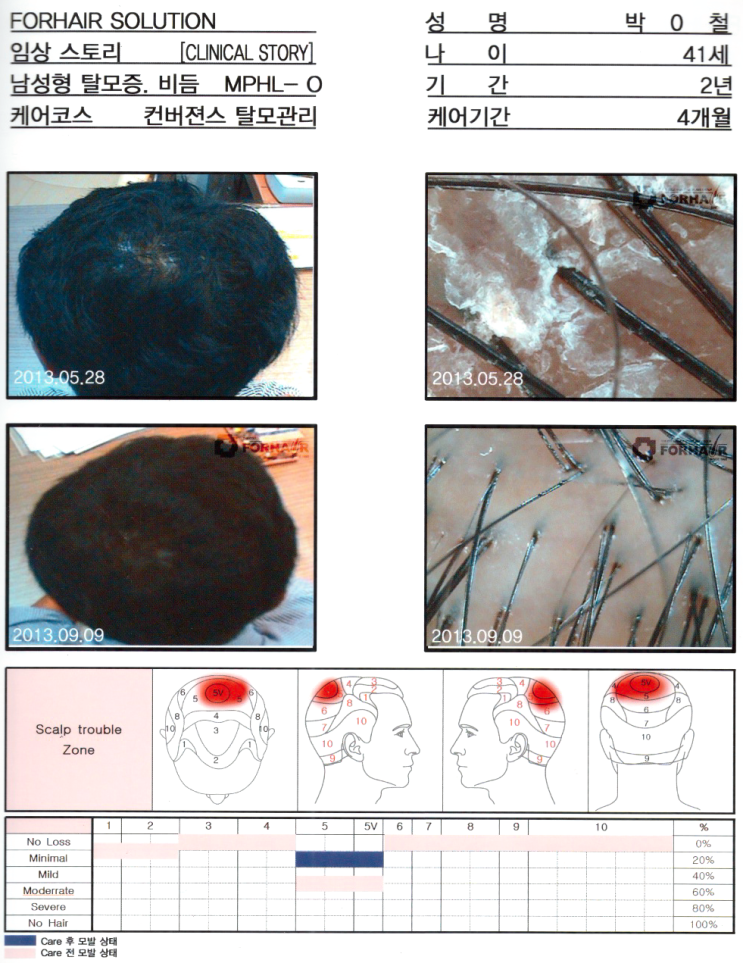 탈모 유형과 치료방법,마곡탈모,발산탈모,탈모진단,탈모검사,탈모치료,탈모관리,두피관리,남성탈모,여성탈모,원형탈모,유전탈모,탈모기준,탈모샴푸