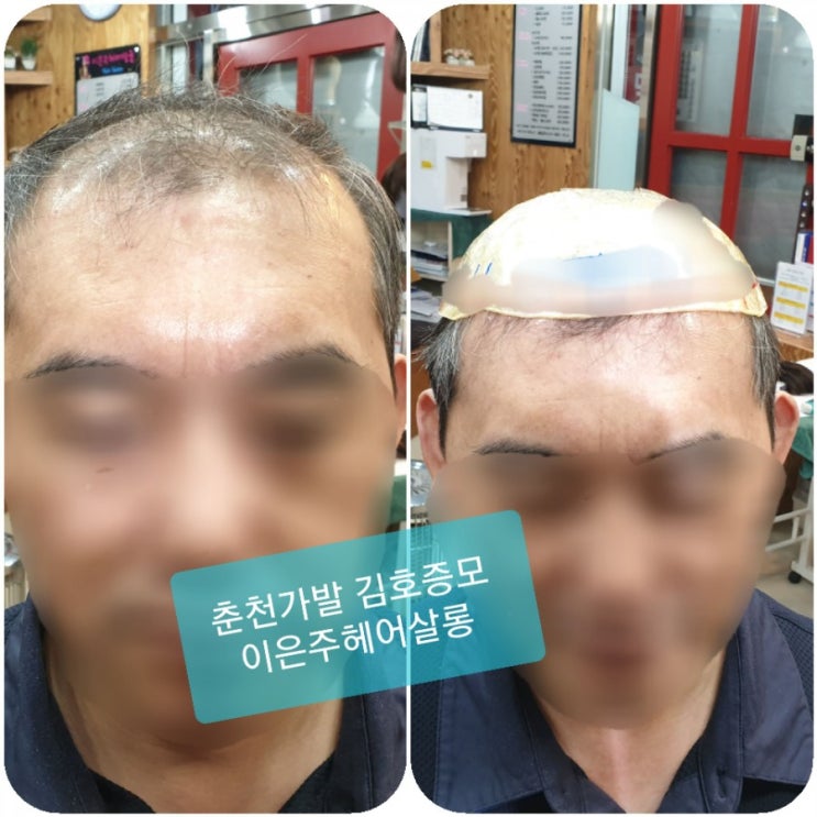  춘천가발 김호증모 클립가발로 견인성 탈모오고 벨크로남자맞춤가발 본뜨기