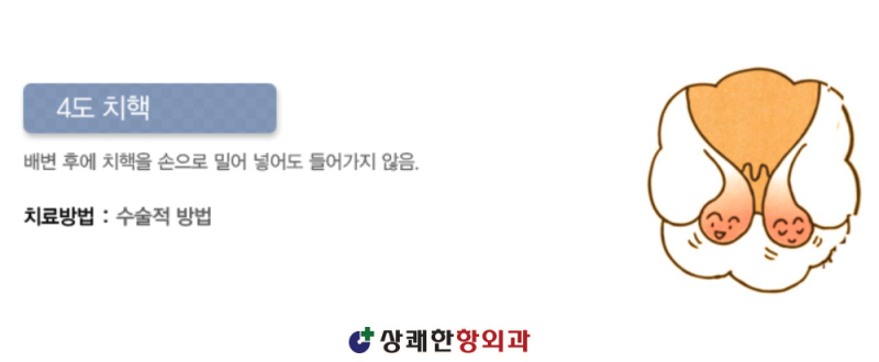 치핵 3기 이상이면 반드시 수술 치료해야 하나요? – 치질 수술의 필요성 : 네이버 블로그
