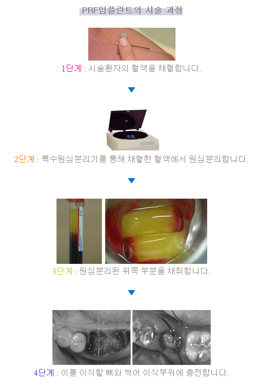 PRF (자가혈이식) Platelet rich fibrin : 네이버 블로그