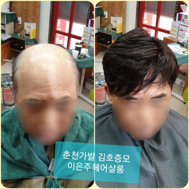  춘천가발 김호증모 고정식가발 관리 받는 날~춘천가발전문점