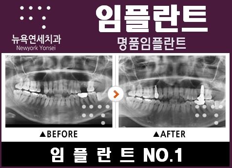  임플란트수술에 사용이 되는 제품, 국산과 외국산의 차이가 큰가요?