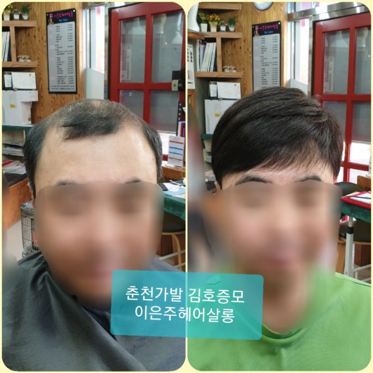  춘천가발 김호증모 춘천가발전문점 30대 남자맞춤가발 피팅 합니다~^^