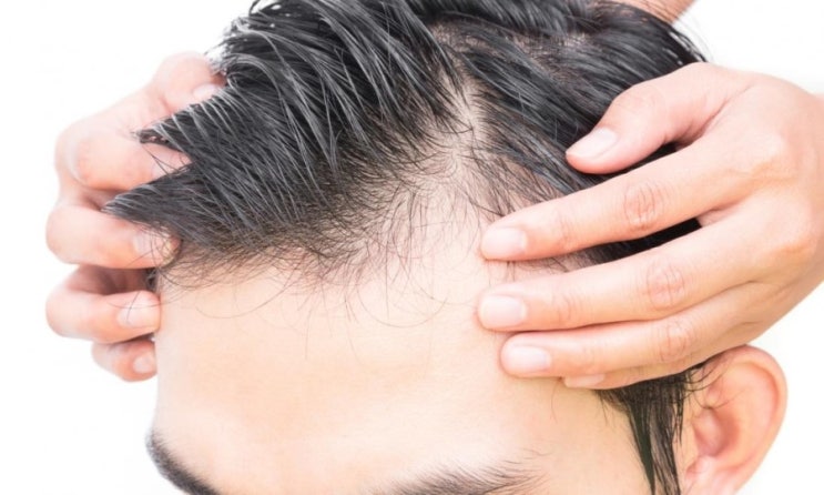 탈모 진단하는 방법,심층분석,의료기록,신체검사,당김 테스트,카드 테스트,삼차분석,곰팡이,펀치생검,혈액검사,철분결핍,갑상선질환,안드로겐과량,사진술 탈모 진단하는 방법,심층분석,의료기록,신체검사,당김 테스트,카드 테스트,삼차분석,곰팡이,펀치생검,혈액검사,철분결핍,갑상선질환,안드로겐과량,사진술