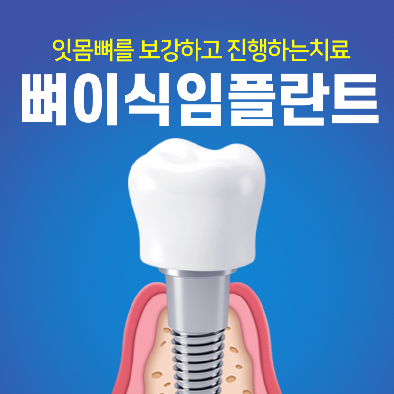 인천치과 잇몸이 소실된 경우에는 골이식 임플란트가 필요합니다.