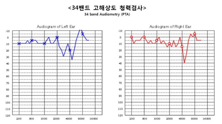  고해상도청력검사가 필요한 이유