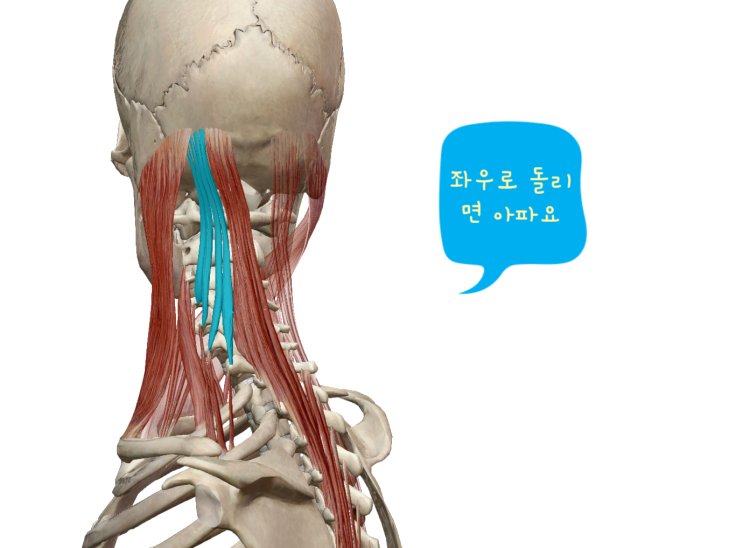 고개 돌릴때 통증, 목 돌릴때 통증 -담결림 고개 돌릴때 통증, 목 돌릴때 통증 -담결림