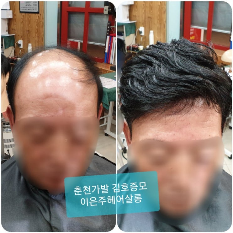  춘천가발 김호증모 춘천맞춤가발전문점 피팅하는 날~^^