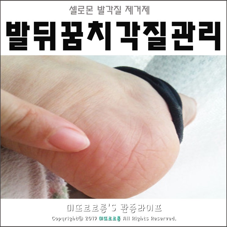  셀로몬 발각질 제거제 발뒤꿈치 각질 원인이 무좀?