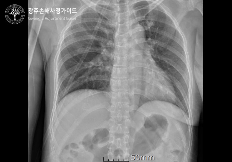 척추압박골절 후유장해 보험금 광주 손해사정 가이드 안내