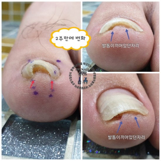 발톱이살을파고들때어떻게하시나요?/분당용인수원수지보정동백죽전동/주네일/파고드는발톱전문네일샵 발톱이살을파고들때어떻게하시나요?/분당용인수원수지보정동백죽전동/주네일/파고드는발톱전문네일샵