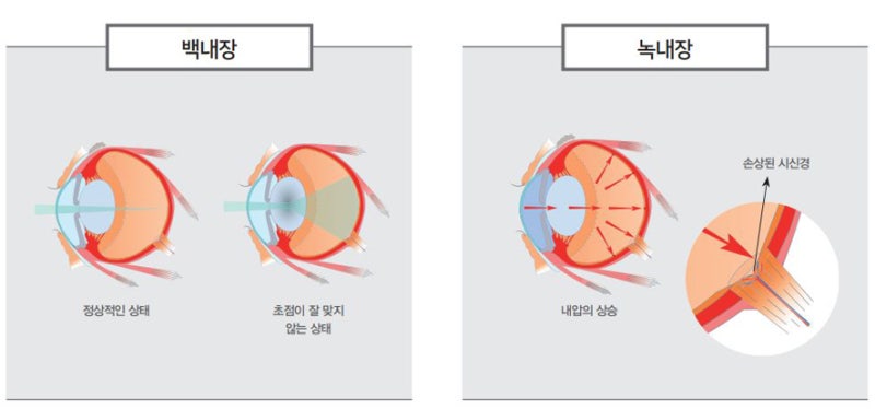 의정부안과 백내장 및 녹내장의 증상 차이와 치료방법에 대한