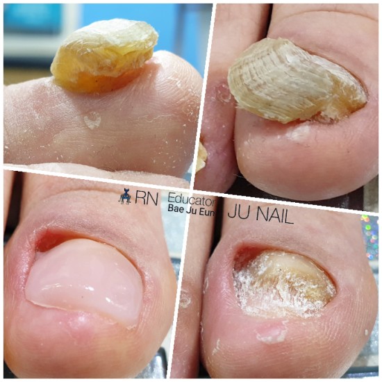 최악의 발톱무좀.. 걷기가 힘들었어요./분당용인수원수지보정동백죽전동/주네일/파고드는발톱전문네일샵 최악의 발톱무좀.. 걷기가 힘들었어요./분당용인수원수지보정동백죽전동/주네일/파고드는발톱전문네일샵