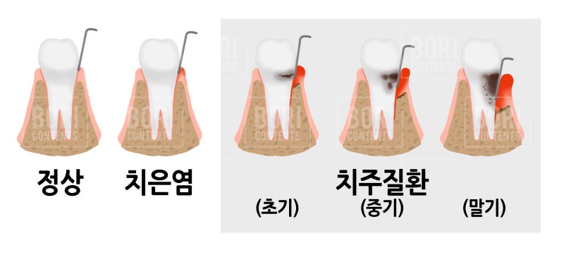 뉴스에서도 강조하는 치주질환 구강검진의 중요성_구강검진시기_잇몸병 예방하자_풍치 증상_풍치 예방 사진 5