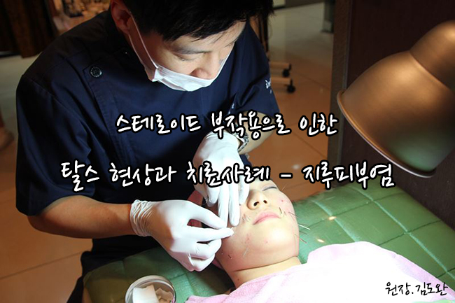  스테로이드 부작용으로 인한 탈스 현상과 치료사례 – 지루피부염