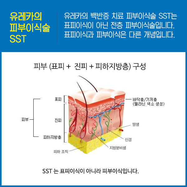 강남역 백반증 치료 피부이식술은 유레카 SST!