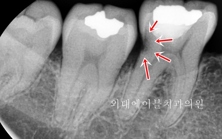 치아 뿌리 충치, 치료가 어려운 치아 살려보기