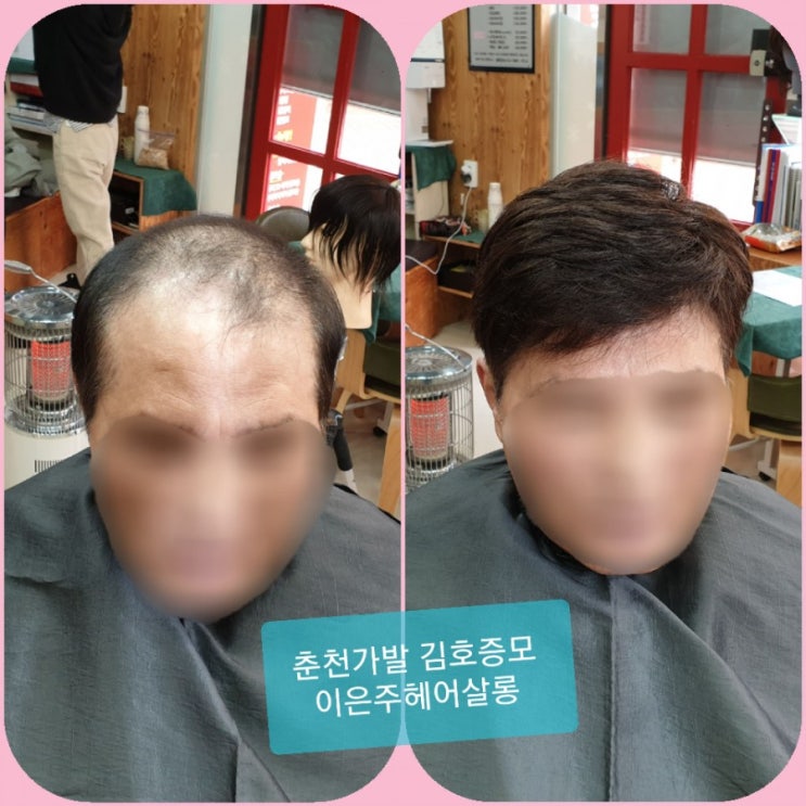  춘천가발 김호증모 남자맞춤가발전문점 자녀결혼을 앞두고 준비한 아빠맞춤가발 피팅합니다~