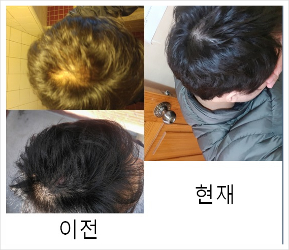  탈모에 좋은 건강식품