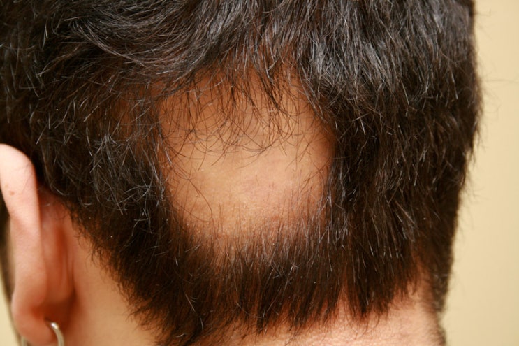 원형 탈모에 대해서 두피 땜빵?강서구 원형 탈모에 대해 잘못알고 있는 사실들! 원형 탈모에 대해서 두피 땜빵?강서구 원형 탈모에 대해 잘못알고 있는 사실들!