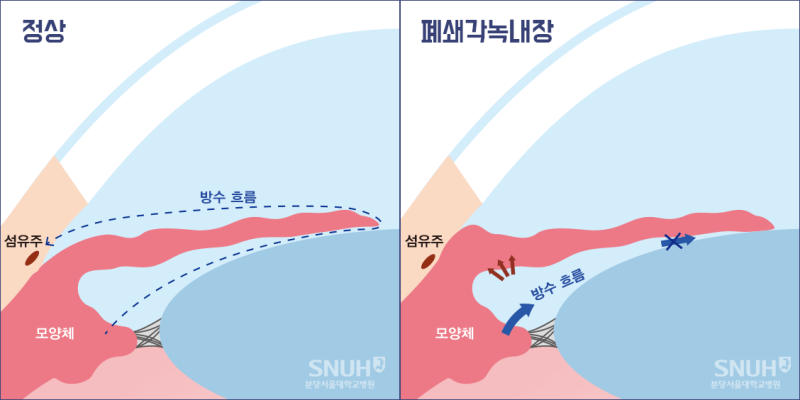 Know Gwangju Glaucoma Symptoms and Self-diagnosis Methods