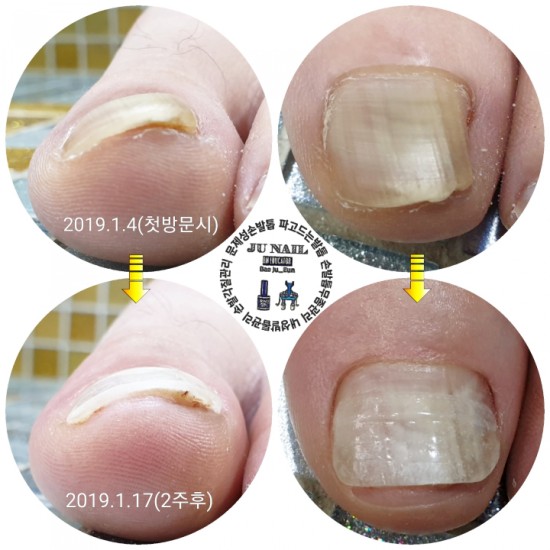 발톱이 살을파고들어 생긴 염증때문에 운동경기 도중 포기했어요./분당용인수원수지보정동백죽전동/주네일/파고드는발톱전문네일샵 발톱이 살을파고들어 생긴 염증때문에 운동경기 도중 포기했어요./분당용인수원수지보정동백죽전동/주네일/파고드는발톱전문네일샵