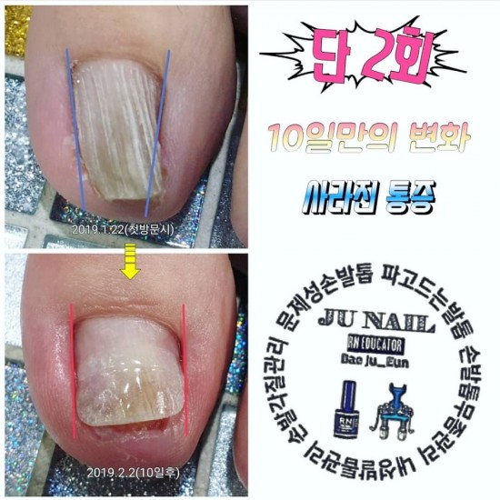 누구에게 말할수도 없는 고민이 되어버리고 살을파고드는 고통과 변해버린 내향성발톱을 수술없이 관리했습니다. /분당용인수원수지보정동백죽전동/주네일/무좀파고드는발톱전문네일샵 누구에게 말할수도 없는 고민이 되어버리고 살을파고드는 고통과 변해버린 내향성발톱을 수술없이 관리했습니다. /분당용인수원수지보정동백죽전동/주네일/무좀파고드는발톱전문네일샵