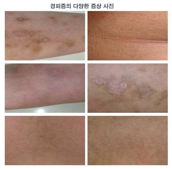 손발 경피증, 왜 피부조직이 딱딱해지나?
