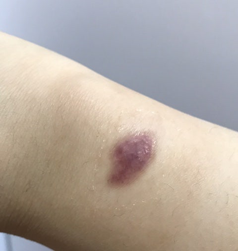 3도 화상 흉터 관리(정말 한 번도 안 되지만)는 계속 노력해야 할 것 같다. 1