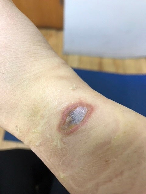 3도 화상 흉터 관리(정말 한 번도 안 되지만)는 계속 노력해야 할 것 같다. 7