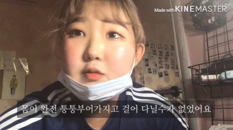  故 최진실 딸 최준희, '난치' 루프스병 고백,모습이 괴물 같았다