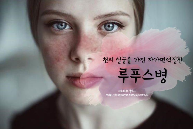  루프스병, 루푸스병, 자가면역질환 - 천의 얼굴을 가진 질병