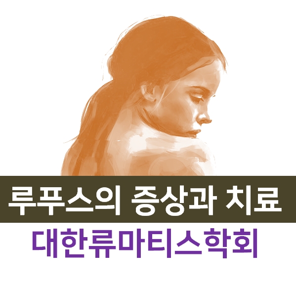  루푸스병 (전신홍반 루푸스)의 증상과 치료. 대한류마티스학회 루푸스병 의학정보
