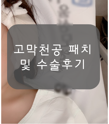 고막천공패치및수술후기[고막천공술,고실성형술]