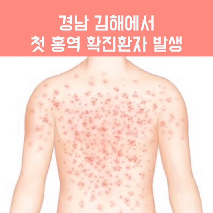  건강정보/경남 김해시 첫 홍역환자 발생