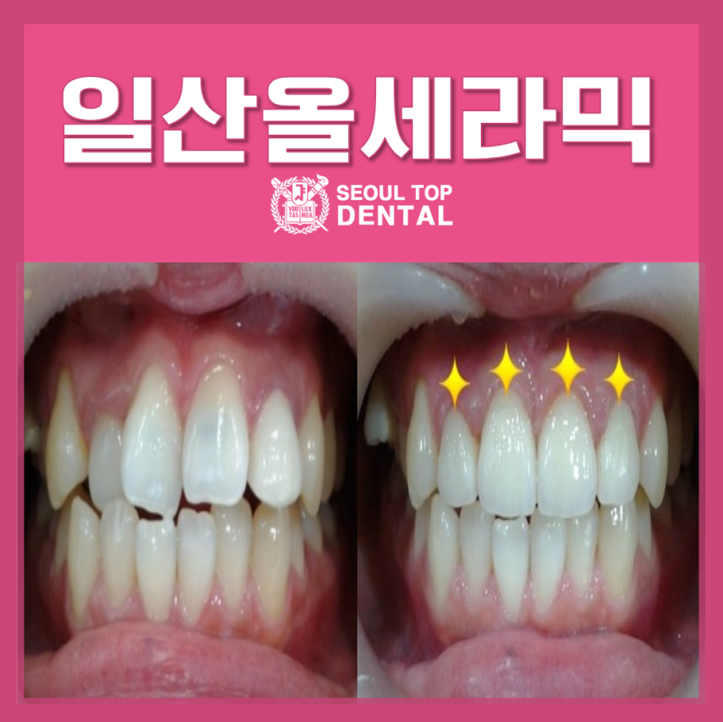 Gaoyang 치과 용 라미네이트와 올 세라믹의 차이점 10