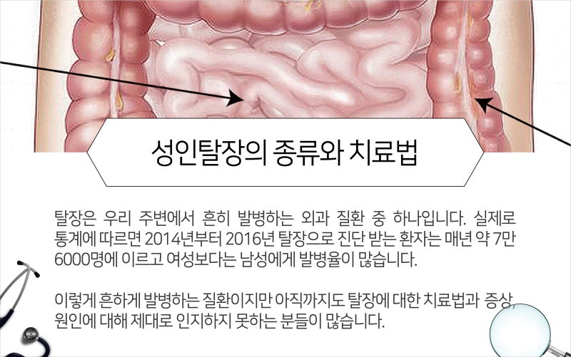 성인탈장 나이가 들수록 조심해야 하는 이유?