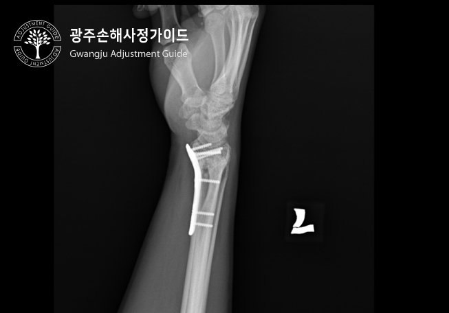광주손해사정가이드 - 요골골절(손목) 후유장해 보험금 보상 : 장한서 손해사정사