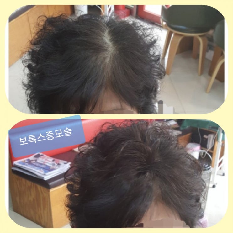  춘천가발 김호증모 탈모고민 보톡스증모술로 해결