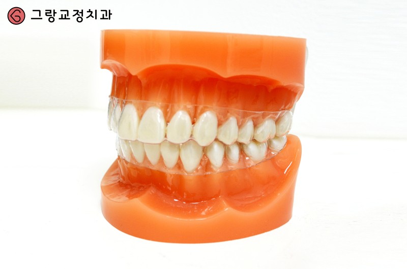 치아교정유지장치가격 알고 제작해야죠! : 네이버 블로그