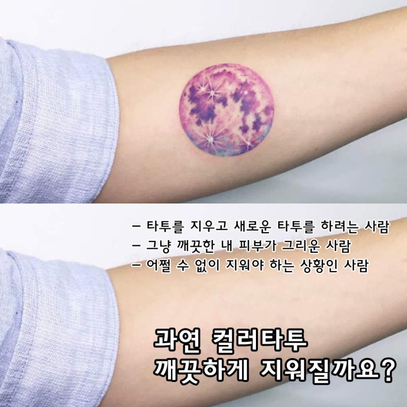 [타투제거후기] 컬러타투제거 리얼 1