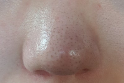 센트라스 피부과 아쿠아필링 모공 블랙헤드 효과 및 부작용