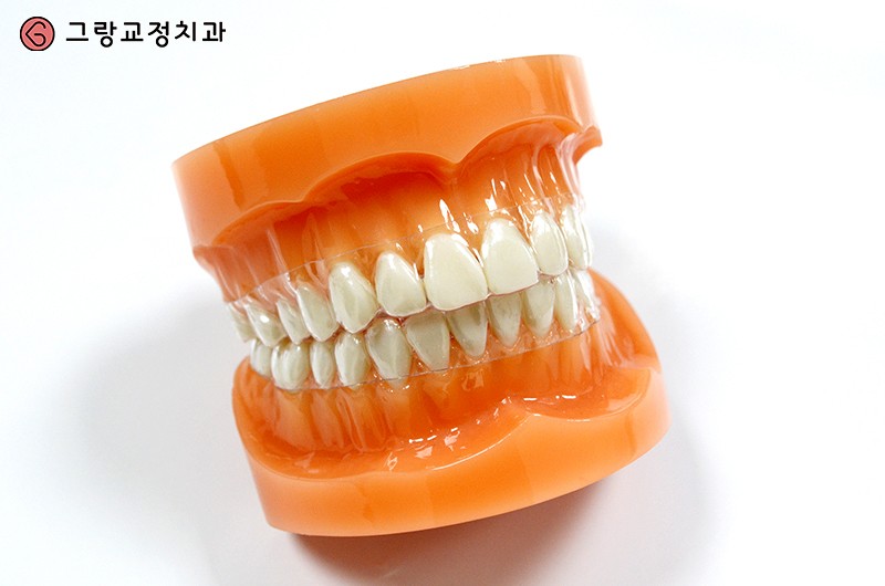 치아교정유지장치가격 알고 제작해야죠! : 네이버 블로그