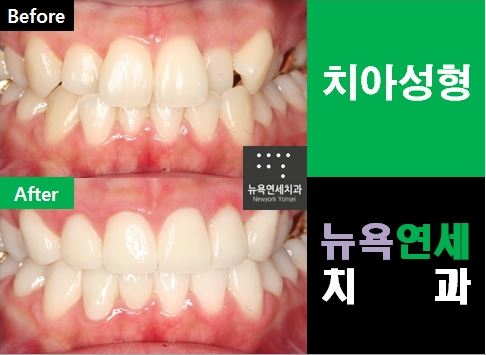  치아성형으로 앞니를 가지런하게 디자인을 하는 심미보철 치료!