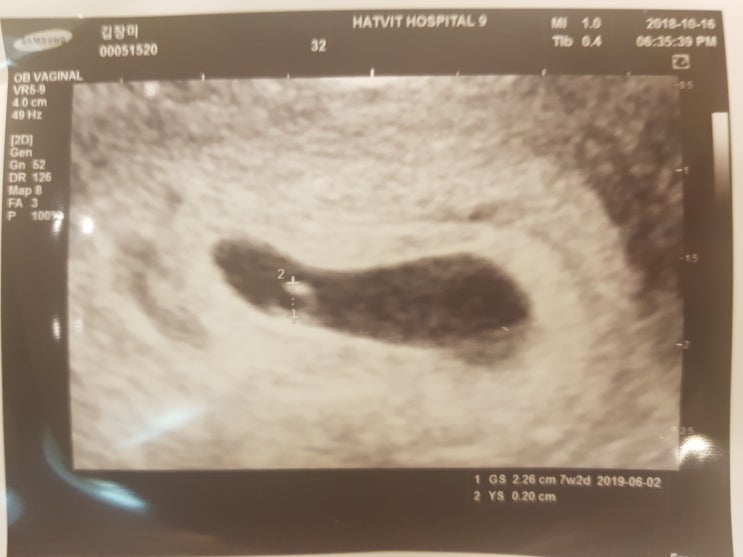  결혼 3년만에 임신, 다낭성이지만 5주차에 임신 확인, 신기방기 초록뱀 태몽