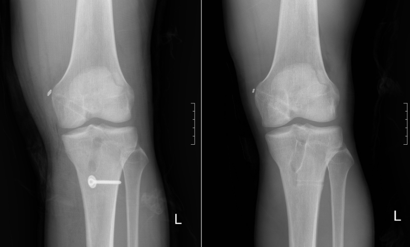 무릎 수술 후 핀제거(전방십자인대 & 무릎 수술 후 핀제거(전방십자인대 &
