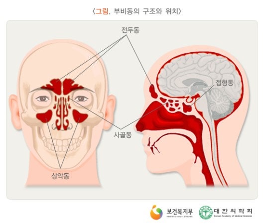 송도축농증 치료 밤마다 코막힘 증상