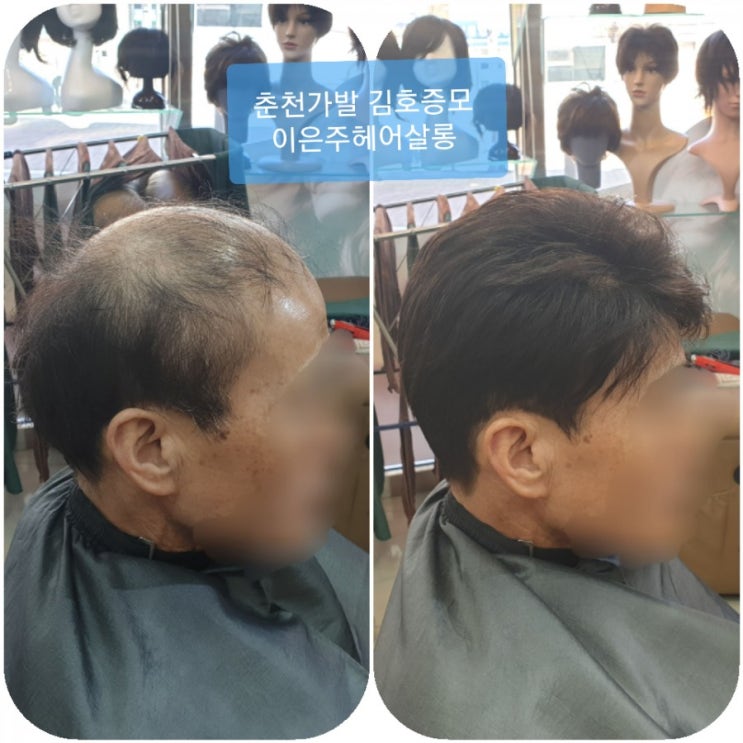  춘천가발 김호증모 남자맞춤가발 관리받는날