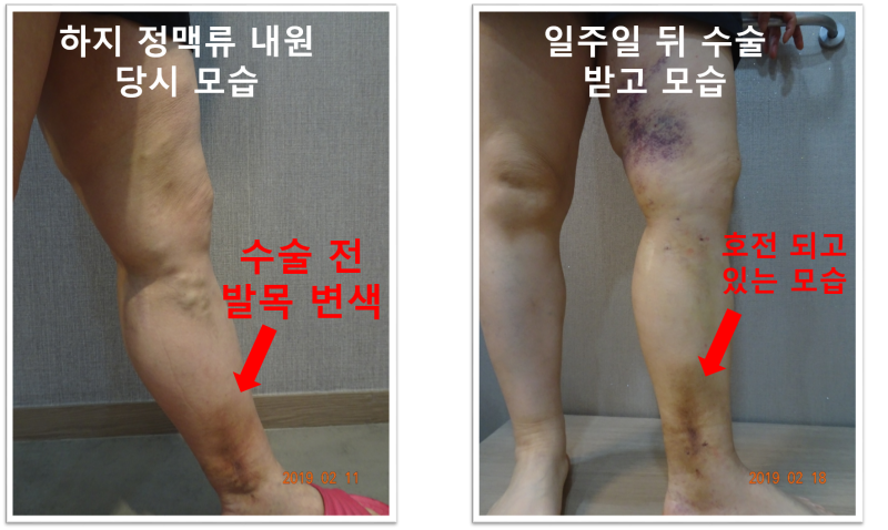 다리, 종아리 가려움증 대처하기/건조증, 한랭 두드러기, 하지정맥류, 하지불안증 원인 및 치료방법/원인불명 가려움증, 통증관리 2