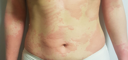 심한 가려움과 따가움으로 고통스러운 만성두드러기와 피부묘기증 심한 가려움과 따가움으로 고통스러운 만성두드러기와 피부묘기증